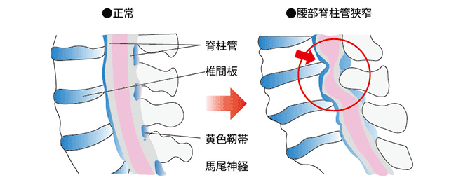脊柱管狭窄症　正常と異常のイラスト